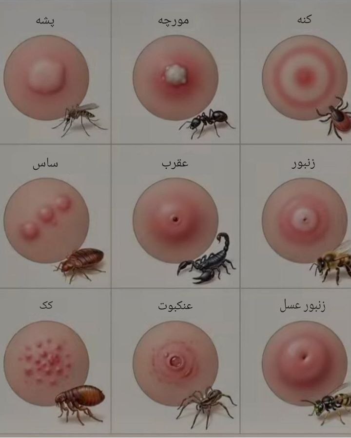 از مدل جای گزش میتونی متوجه بشی چه حشره ای نیشت زده: @cognito